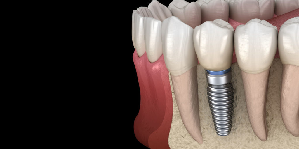 Severe Bone Loss | Waynesboro, VA | Charlottesville, VA